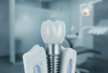 Nahaufnahme eines modernen Zahnimplantats, das sich in eine knochenähnliche Struktur integriert, mit einem verschwommenen Hintergrund einer zahnärztlichen High-Tech-Klinik. Fokus auf Präzision und Innovation in der dentalen Implantologie in Deutschland.