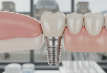 Ultra-detaillierte Nahaufnahme eines perfekt integrierten Zahnimplantats in einem gesunden menschlichen Gebiss, umgeben von sauberem Zahnfleisch. Das Implantat und die Zahnkrone wirken sehr natürlich. Der Hintergrund ist unscharf und deutet auf eine moderne Zahnklinik hin, mit einem extrem subtilen, verschwommenen Hinweis auf eine Berliner Stadtansicht im äußersten Hintergrund.